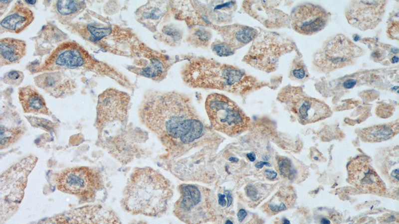 Immunohistochemistry of paraffin-embedded human lung cancer tissue slide using Catalog No:112488(SERPINB5 Antibody) at dilution of 1:200 (under 40x lens). heat mediated antigen retrieved with Tris-EDTA buffer(pH9).