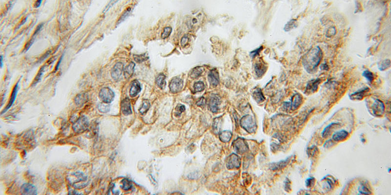 Immunohistochemical of paraffin-embedded human pancreas cancer using Catalog No:108013(AMY2B antibody) at dilution of 1:50 (under 10x lens)