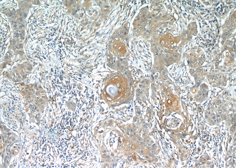 Immunohistochemical of paraffin-embedded human lung cancer using Catalog No:112892(MUC8 antibody) at dilution of 1:50 (under 10x lens)