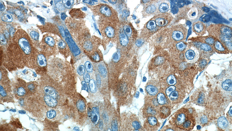 Immunohistochemical of paraffin-embedded human liver cancer using Catalog No:114562(RBP4 antibody) at dilution of 1:50 (under 40x lens)