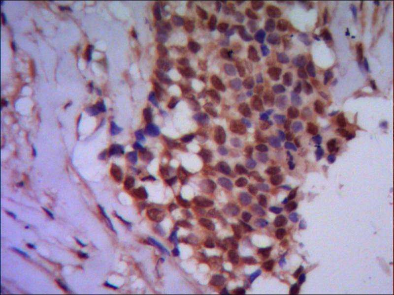 IHC of paraffin-embedded human breast cancer using anti-Protein Phosphatase 4C mouse mAb diluted 1/500-1/1000.