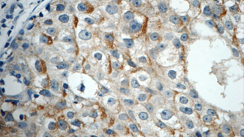 Immunohistochemistry of paraffin-embedded human breast cancer tissue slide using Catalog No:114502(RABL3 Antibody) at dilution of 1:50 (under 40x lens)