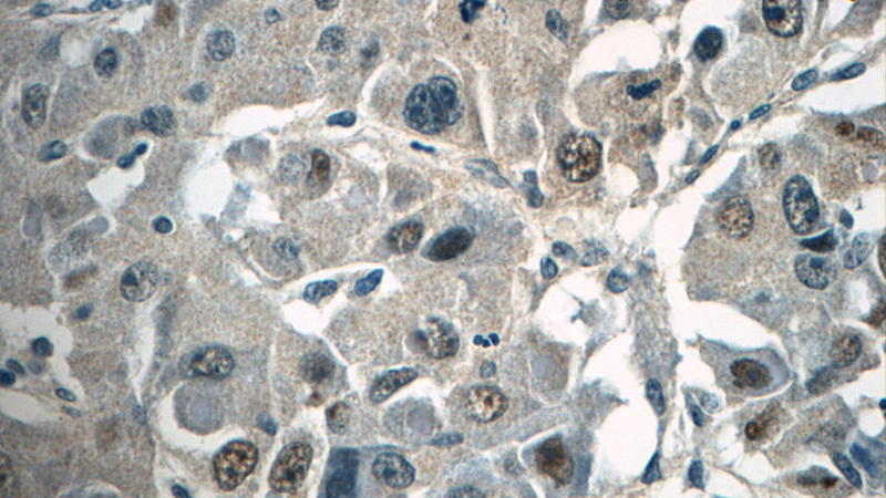 Immunohistochemistry of paraffin-embedded human liver cancer tissue slide using Catalog No:116416(TRPT1 Antibody) at dilution of 1:50 (under 40x lens)