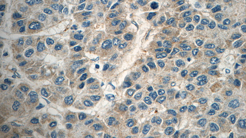 Immunohistochemistry of paraffin-embedded human liver cancer tissue slide using Catalog No:111394(HEBP1 Antibody) at dilution of 1:50 (under 40x lens)