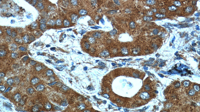 Immunohistochemistry of paraffin-embedded human lung cancer tissue slide using Catalog No:117189(BLoc1S3 Antibody) at dilution of 1:50 (under 40x lens)