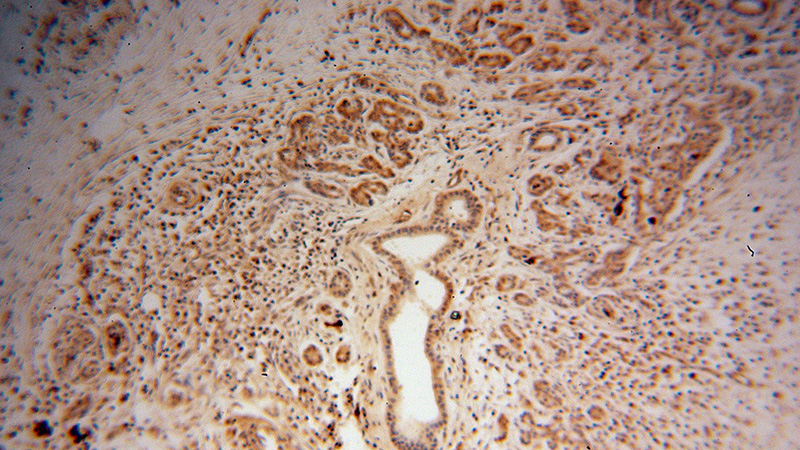 Immunohistochemical of paraffin-embedded human pancreas cancer using Catalog No:108181(ARHGDIG antibody) at dilution of 1:100 (under 10x lens)