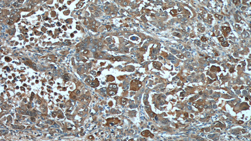 Immunohistochemistry of paraffin-embedded human liver cancer tissue slide using Catalog No:114963(S100A6 Antibody) at dilution of 1:200 (under 10x lens).