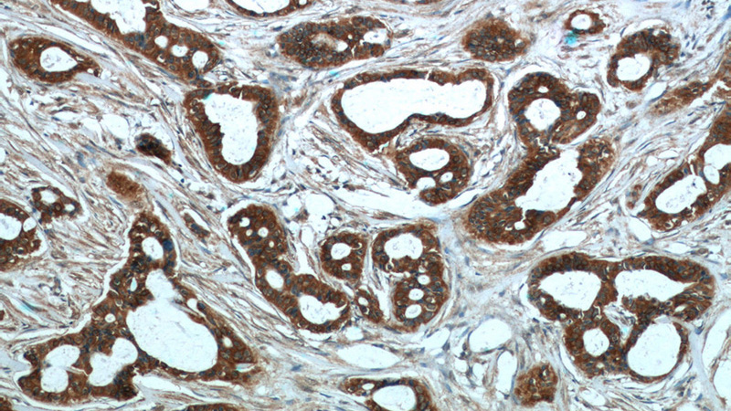 Immunohistochemistry of paraffin-embedded human breast cancer tissue slide using Catalog No:109809(KRT7 Antibody) at dilution of 1:50 (under 10x lens)