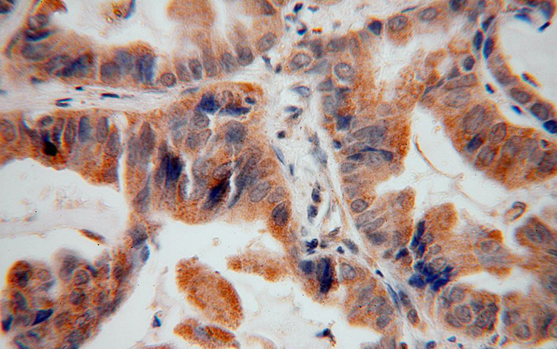 Immunohistochemical of paraffin-embedded human lung cancer using Catalog No:110605(FCRLB antibody) at dilution of 1:100 (under 40x lens)