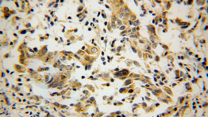 Immunohistochemical of paraffin-embedded human breast cancer using Catalog No:115033(SDHC antibody) at dilution of 1:100 (under 40x lens)