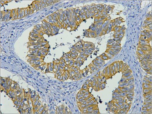 IHC staining of human colon cancer tissue with CK19 mouse mAb(11F5) diluted at 1:200.