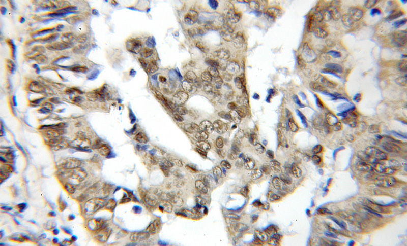 Immunohistochemical of paraffin-embedded human colon cancer using Catalog No:108555(BUD31 antibody) at dilution of 1:100 (under 10x lens)
