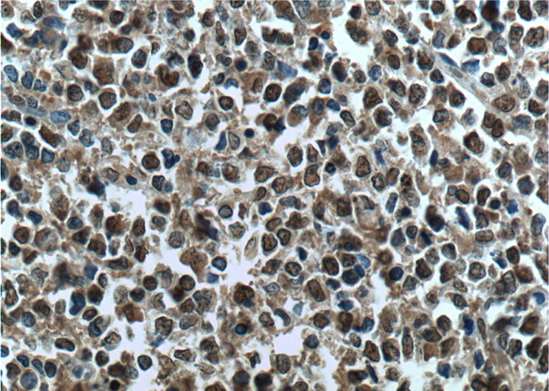 Immunohistochemistry of paraffin-embedded human lymphoma tissue slide using Catalog No:115431(SMARCB1 Antibody) at dilution of 1:200 (under 40x lens). heat mediated antigen retrieved with Tris-EDTA buffer(pH9).