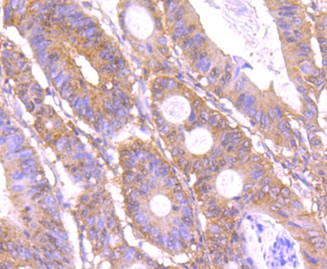 Fig4: Immunohistochemical analysis of paraffin-embedded human colon cancer tissue using anti-C12orf51 antibody. Counter stained with hematoxylin.