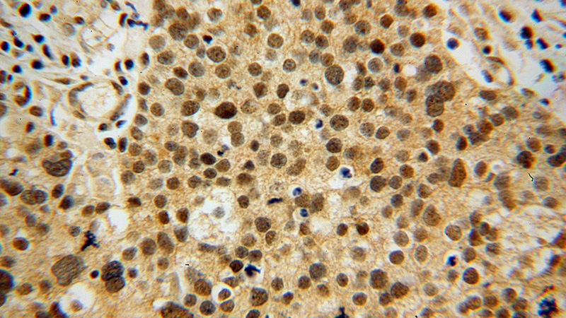 Immunohistochemical of paraffin-embedded human ovary tumor using Catalog No:113432(OSBPL2 antibody) at dilution of 1:100 (under 40x lens)