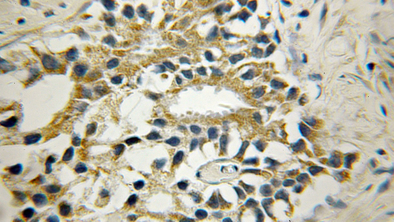 Immunohistochemical of paraffin-embedded human prostate cancer using Catalog No:115842(MAP3K7 antibody) at dilution of 1:50 (under 10x lens)