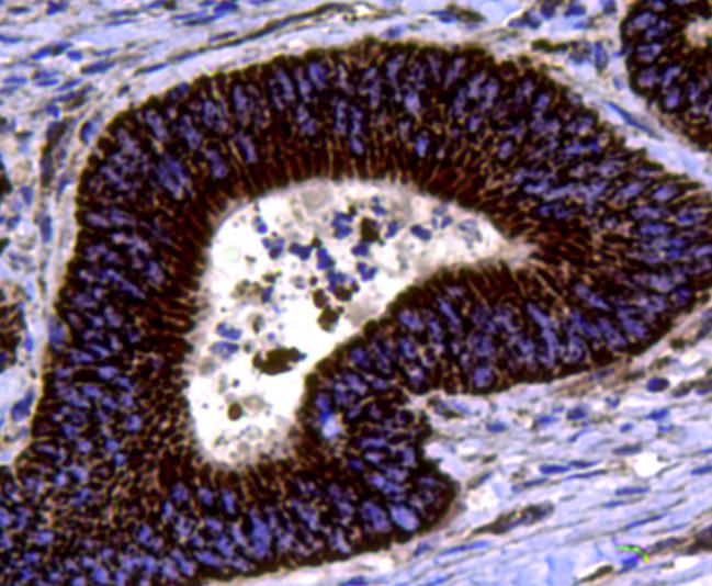 Fig3: Immunohistochemical analysis of paraffin-embedded human colon cancer tissue using anti-chromogranin A antibody. Counter stained with hematoxylin.