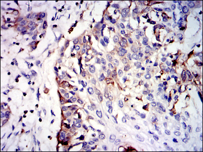 Immunohistochemical analysis of paraffin-embedded esophageal cancer tissues using GSTM1 mouse mAb with DAB staining.
