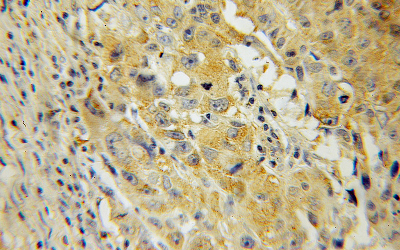 Immunohistochemical of paraffin-embedded human lung cancer using Catalog No:111786(IMPDH2 antibody) at dilution of 1:100 (under 10x lens)