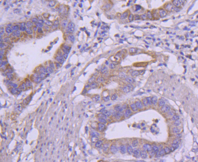 Fig5:; Immunohistochemical analysis of paraffin-embedded human stomach carcinoma tissue using anti-Ret antibody. The section was pre-treated using heat mediated antigen retrieval with Tris-EDTA buffer (pH 8.0-8.4) for 20 minutes.The tissues were blocked in 5% BSA for 30 minutes at room temperature, washed with ddH; 2; O and PBS, and then probed with the primary antibody ( 1/50) for 30 minutes at room temperature. The detection was performed using an HRP conjugated compact polymer system. DAB was used as the chromogen. Tissues were counterstained with hematoxylin and mounted with DPX.