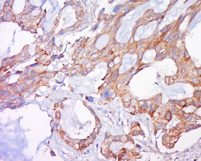 Fig3: Tissue/cell: human lung carcinoma; 4% Paraformaldehyde-fixed and paraffin-embedded;; Antigen retrieval: citrate buffer ( 0.01M, pH 6.0 ), Boiling bathing for 15min; Block endogenous peroxidase by 3% Hydrogen peroxide for 30min; Blocking buffer (normal goat serum,C-0005) at 37℃ for 20 min;; Incubation: Anti-Bak Polyclonal Antibody, Unconjugated 1:500, overnight at 4℃, followed by conjugation to the secondary antibody(SP-0023) and DAB(C-0010) staining