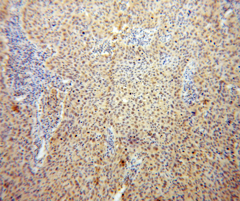 Immunohistochemical of paraffin-embedded human cervical cancer using Catalog No:116585(USP1 antibody) at dilution of 1:100 (under 10x lens)