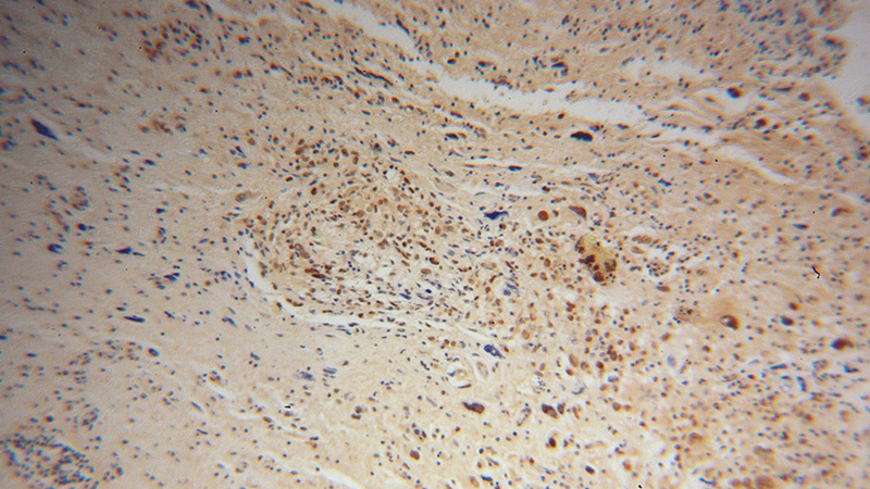 Immunohistochemical of paraffin-embedded human gliomas using Catalog No:108134(ANAPC2 antibody) at dilution of 1:100 (under 10x lens)