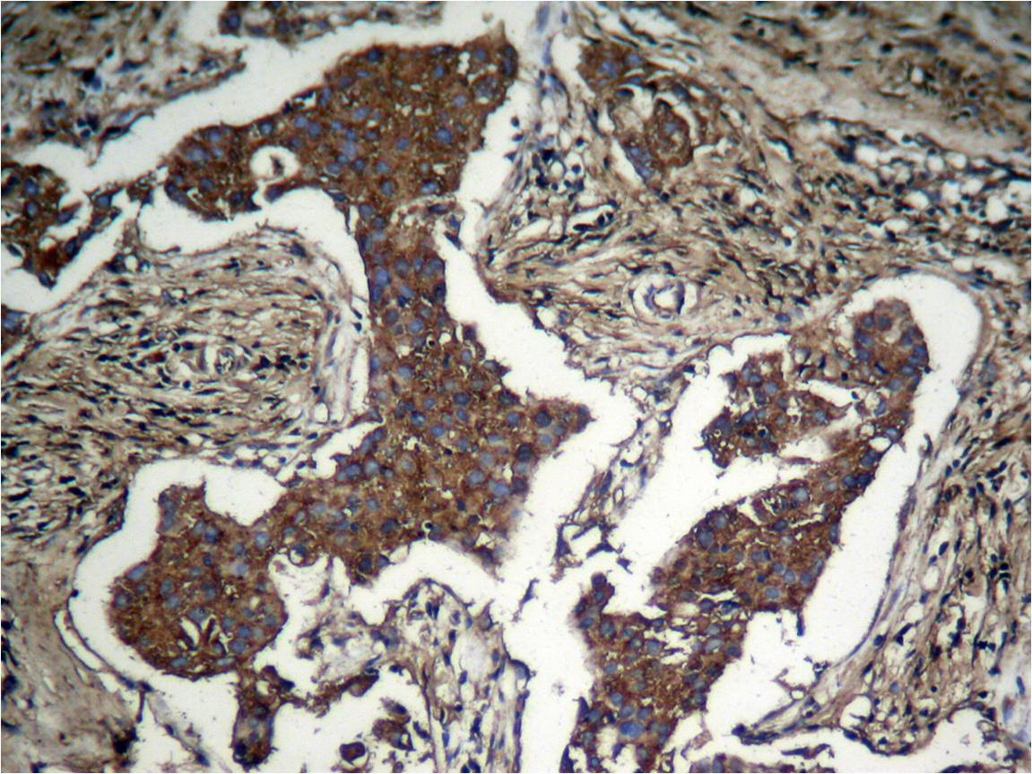 Immunohistochemical analysis of paraffin-nembedded human Lung carcinoma tissue using nAkt (Phospho-Ser473) Antibody .