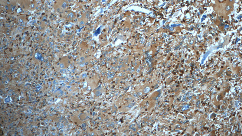 Immunohistochemistry of paraffin-embedded human gliomas tissue slide using Catalog No:108168(ARPC5 Antibody) at dilution of 1:50 (under 10x lens)