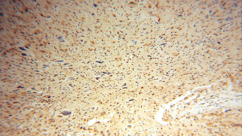 Immunohistochemical of paraffin-embedded human gliomas using Catalog No:109603(CSNK2A1 antibody) at dilution of 1:100 (under 10x lens)