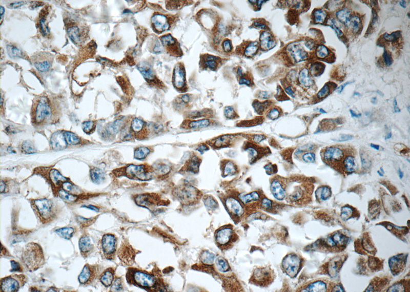 Immunohistochemistry of paraffin-embedded human malignant melanoma tissue slide using Catalog No:112672(MLANA Antibody) at dilution of 1:50 (under 40x lens)