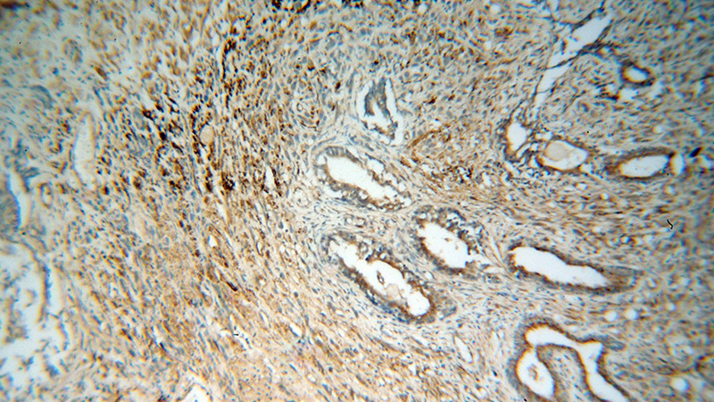 Immunohistochemical of paraffin-embedded human prostate cancer using Catalog No:111171(GSK3B antibody) at dilution of 1:100 (under 10x lens)