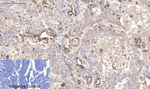 Immunohistochemical analysis of paraffin-embedded Human-lung-cancer tissue. 1,CD45 Monoclonal Antibody(12A9) was diluted at 1:200(4°C,overnight). 2, Sodium citrate pH 6.0 was used for antibody retrieval(>98°C,20min). 3,Secondary antibody was diluted at 1:200(room tempeRature, 30min). Negative control was used by secondary antibody only.