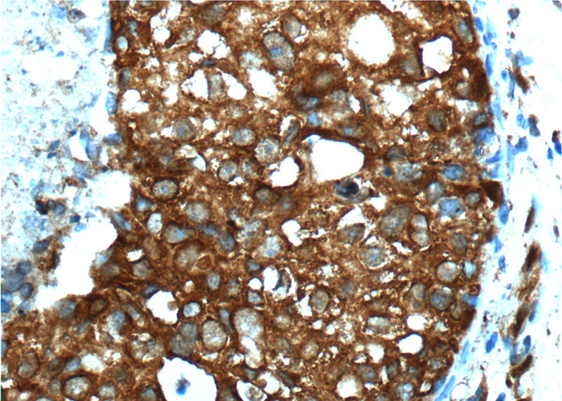 Immunohistochemistry of paraffin-embedded human breast cancer tissue slide using Catalog No:107077(BAX Antibody) at dilution of 1:200 (under 40x lens). heat mediated antigen retrieved with Tris-EDTA buffer(pH9).