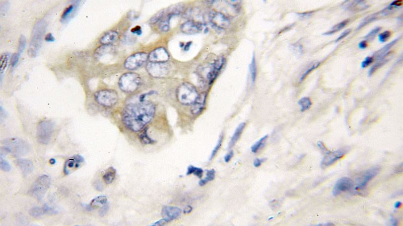 Immunohistochemical of paraffin-embedded human pancreas cancer using Catalog No:116986(XIAP antibody) at dilution of 1:200 (under 40x lens)