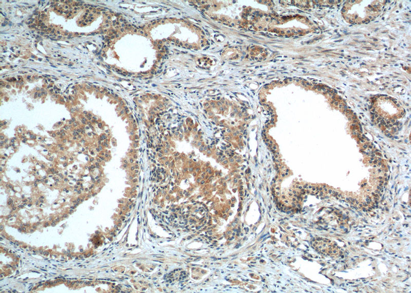 Immunohistochemistry of paraffin-embedded human prostate cancer tissue slide using Catalog No:109662(Cyclin B1 Antibody) at dilution of 1:50 (under 10x lens). heat mediated antigen retrieved with Tris-EDTA buffer(pH9).