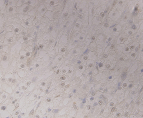 Fig7: Immunohistochemical analysis of paraffin-embedded human renal cell carcinoma tissue using anti-GRAMD1A antibody. Counter stained with hematoxylin.
