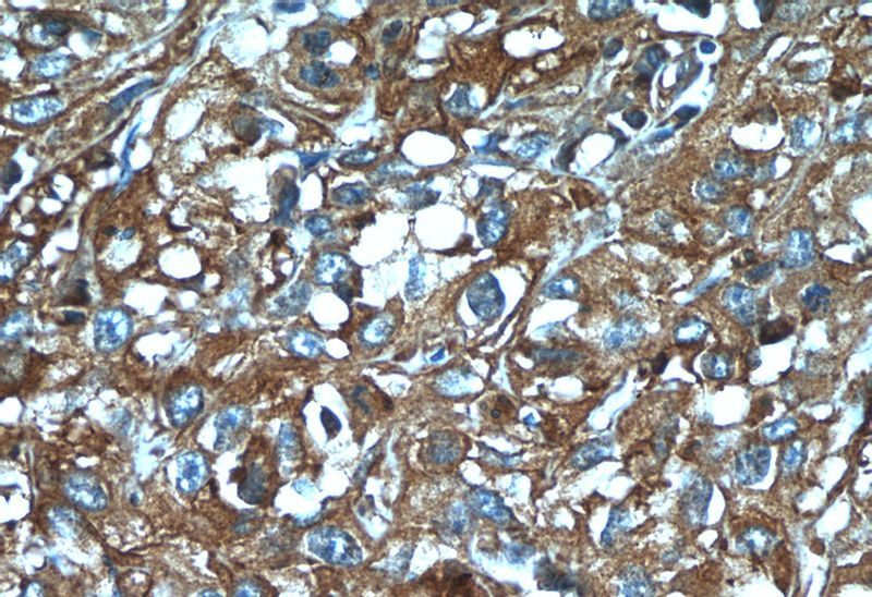Immunohistochemistry of paraffin-embedded human cervical cancer tissue slide using Catalog No:112093(KLHL14-Specific Antibody) at dilution of 1:50 (under 40x lens)