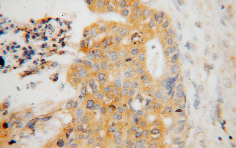 Immunohistochemical of paraffin-embedded human stomach cancer using Catalog No:108308(ATP6V1C1 antibody) at dilution of 1:50 (under 40x lens)