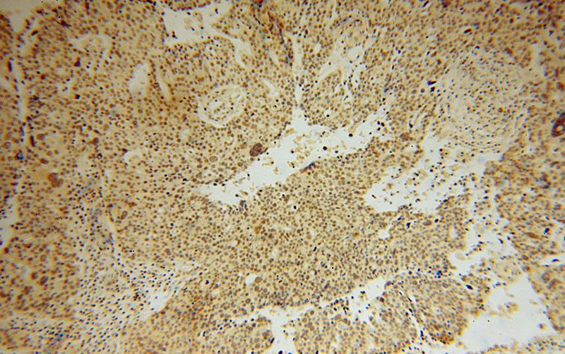 Immunohistochemical of paraffin-embedded human ovary tumor using Catalog No:116049(THoc6 antibody) at dilution of 1:50 (under 10x lens)