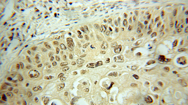 Immunohistochemical of paraffin-embedded human cervical cancer using Catalog No:109827(DDX3 antibody) at dilution of 1:50 (under 10x lens)