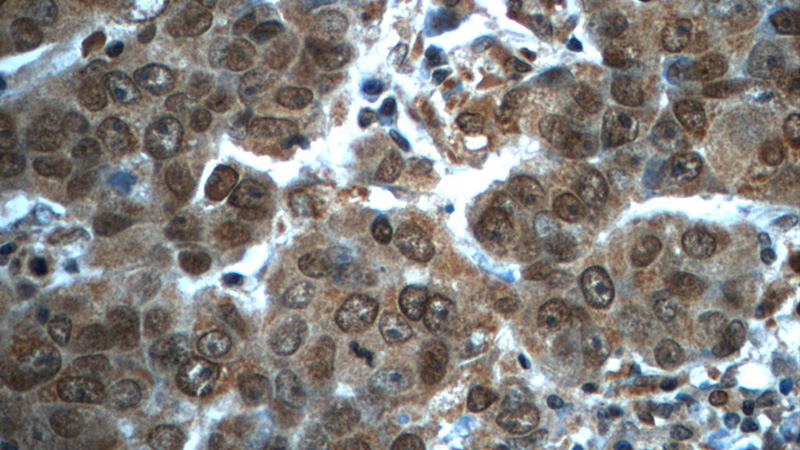 Immunohistochemistry of paraffin-embedded human prostate cancer tissue slide using Catalog No:114066(POTEA Antibody) at dilution of 1:50 (under 40x lens)