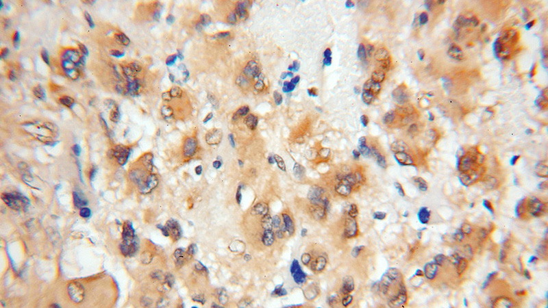 Immunohistochemical of paraffin-embedded human gliomas using Catalog No:115122(SEPT8 antibody) at dilution of 1:50 (under 10x lens)
