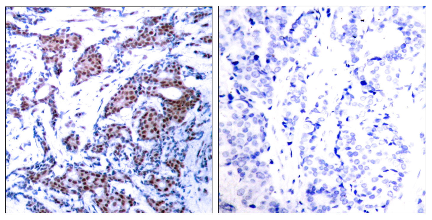 Immunohistochemical analysis of paraffin-embedded human breast carcinoma tissue using c-Jun (Phospho-Ser73) Antibody (left) or the same antibody preincubated with blocking peptide (right).