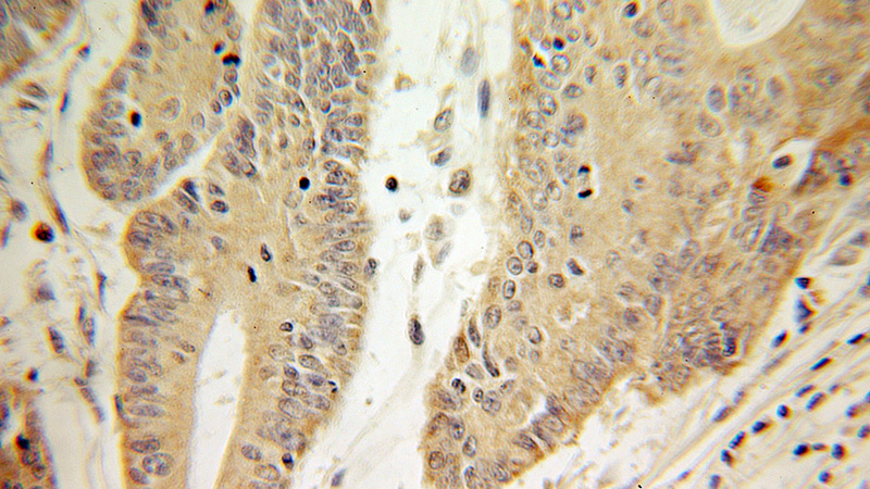 Immunohistochemical of paraffin-embedded human colon cancer using Catalog No:111333(HADHA antibody) at dilution of 1:100 (under 40x lens)