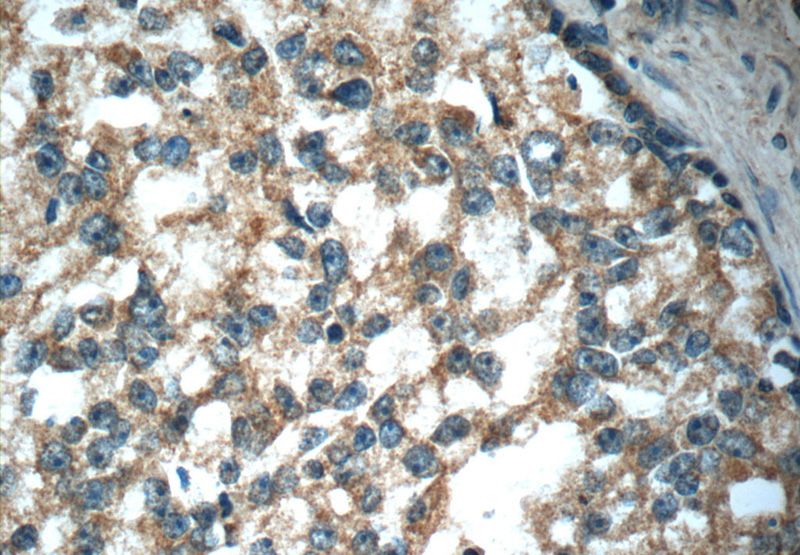 Immunohistochemistry of paraffin-embedded human prostate cancer slide using Catalog No:110923(GDEP Antibody) at dilution of 1:50. (under 40x lens)