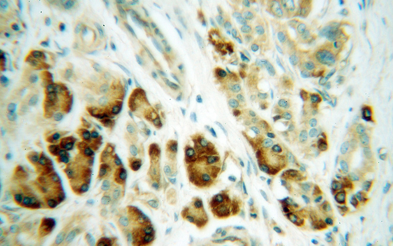 Immunohistochemical of paraffin-embedded human pancreas cancer using Catalog No:114908(SCAR antibody) at dilution of 1:100 (under 40x lens)