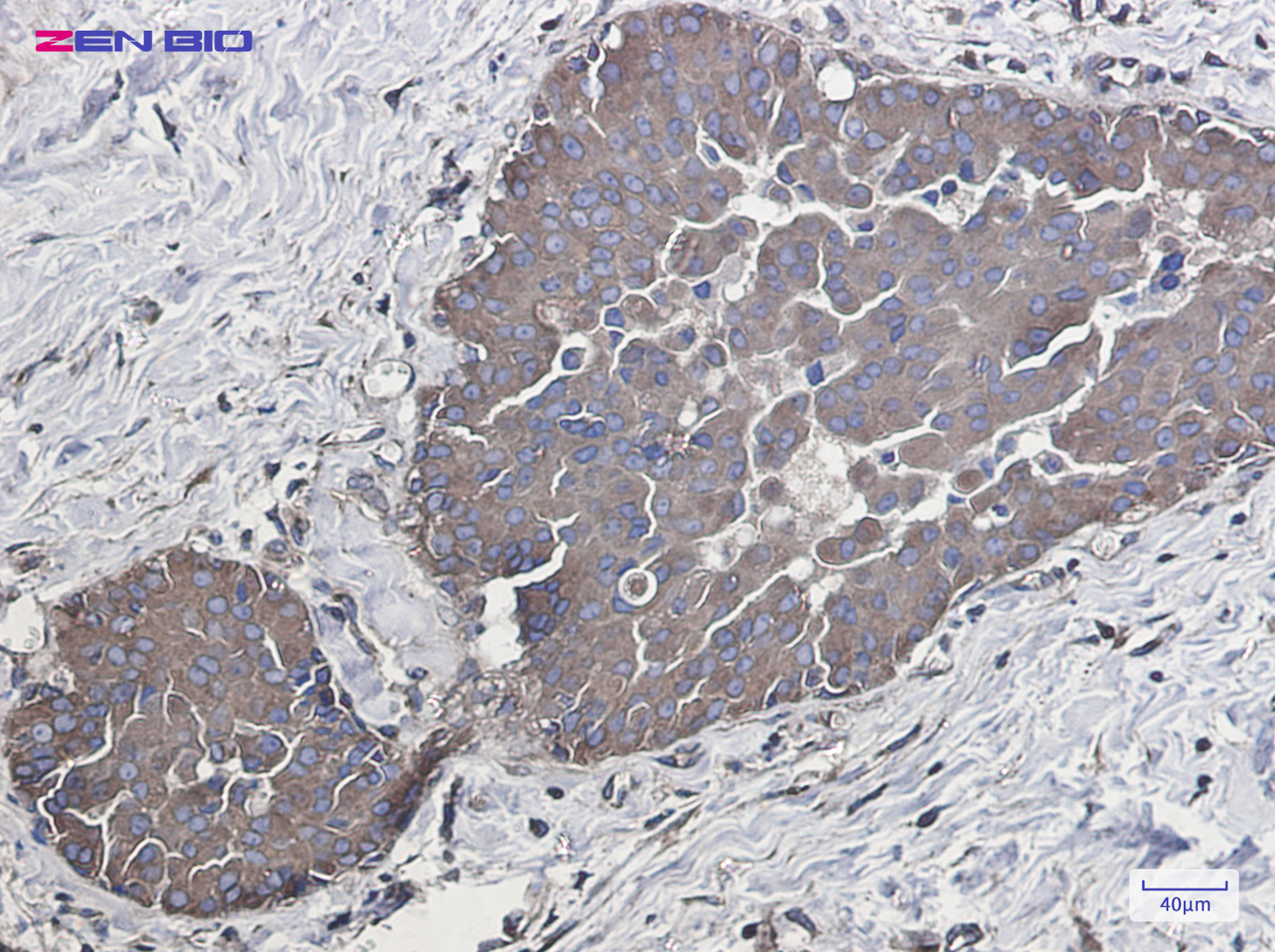 Immunohistochemistry of Rab5 in paraffin-embedded Human breast cancer tissue using Rab5 Rabbit pAb at dilution 1/50
