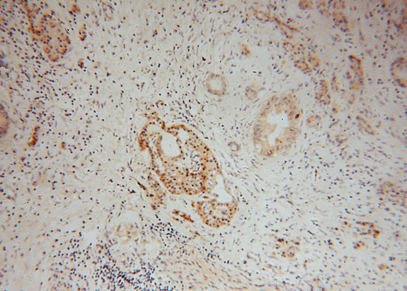 Immunohistochemical of paraffin-embedded human pancreas cancer using Catalog No:108296(ATG4B antibody) at dilution of 1:50 (under 10x lens)