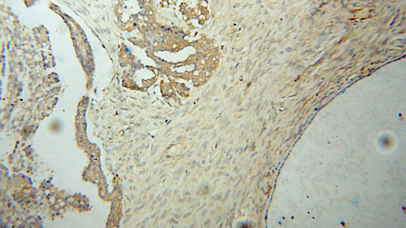 Immunohistochemical of paraffin-embedded human ovary tumor using Catalog No:116413(WARS antibody) at dilution of 1:100 (under 10x lens)